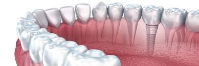 Dental impant.jpg